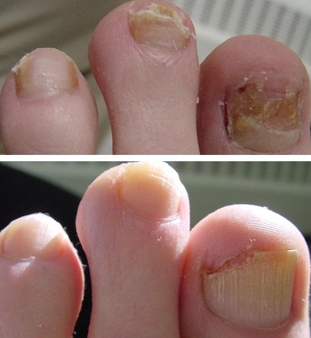 лечение грибка ногтей ног лазером