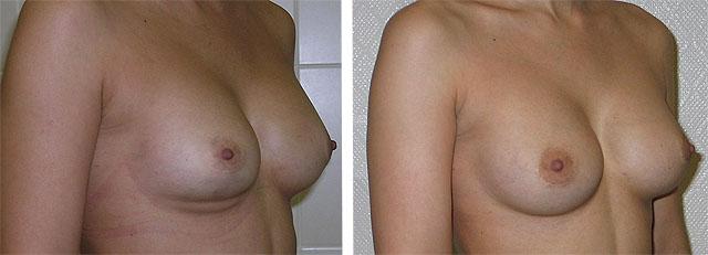 Маммарный фиброз правой груди