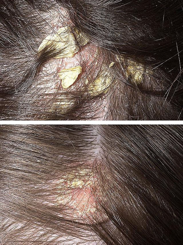 Фото себорейного дерматита волосистой части головы