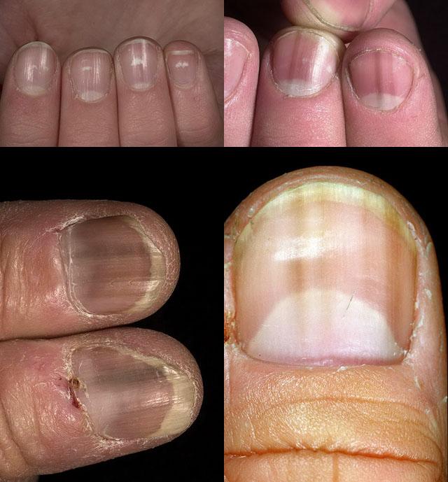 лечение дистрофии ногтей