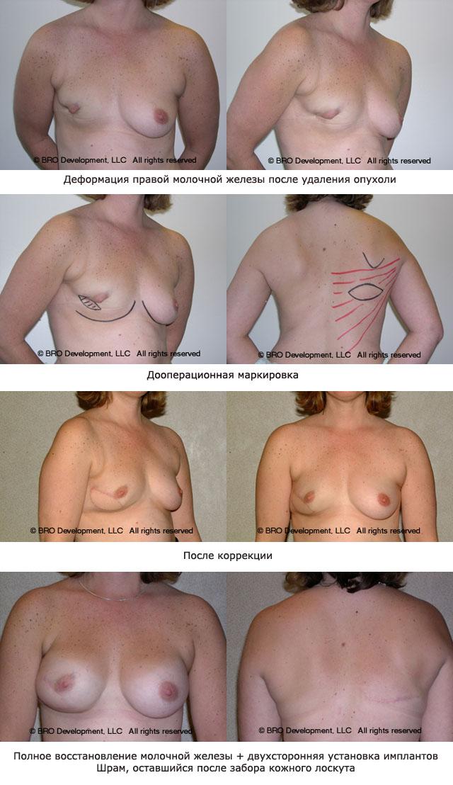 реконструкция груди после мастэктомии