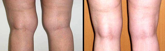 Процедура лазерної ліпосакції стегон і колін » журнал здоров'я iHealth 5