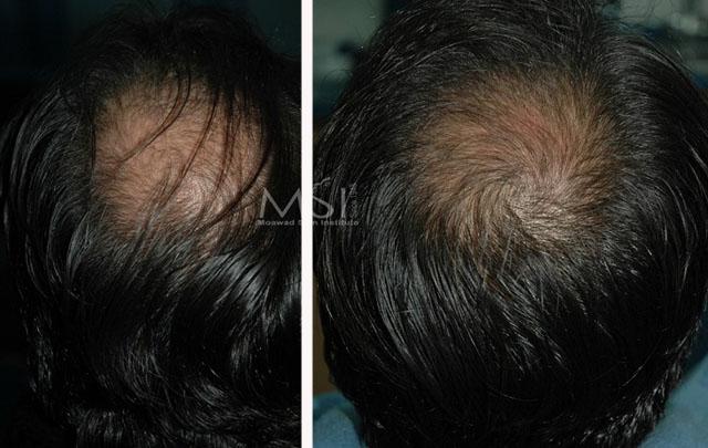 Мезотерапія для волосся - процедура для здорового блиску та об'єму » журнал здоров'я iHealth 1