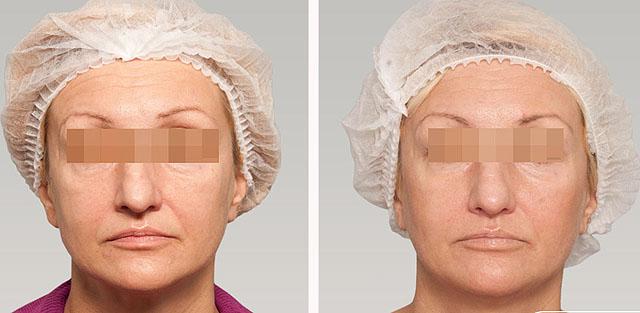 редермализация кожи лица