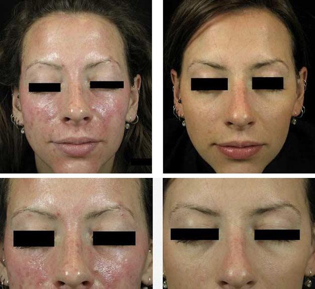 Кислотний пілінг для обличчя: про види впливу і кислотах у подробицях » журнал здоров'я iHealth 5