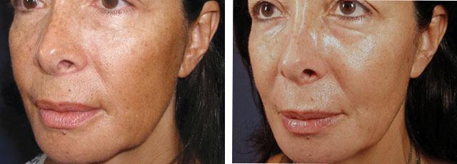Кислотний пілінг для обличчя: про види впливу і кислотах у подробицях » журнал здоров'я iHealth 3