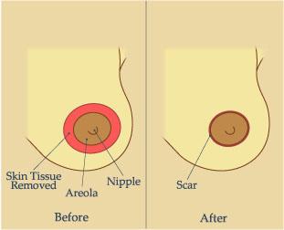 Разрез при периареолярной мастопексии