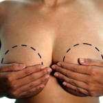Редукционная маммопластика – когда большая грудь становится проблемой