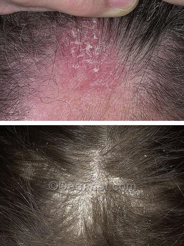 Себорейний дерматит обличчя і волосистої частини голови: причини і лікування » журнал здоров'я iHealth 1
