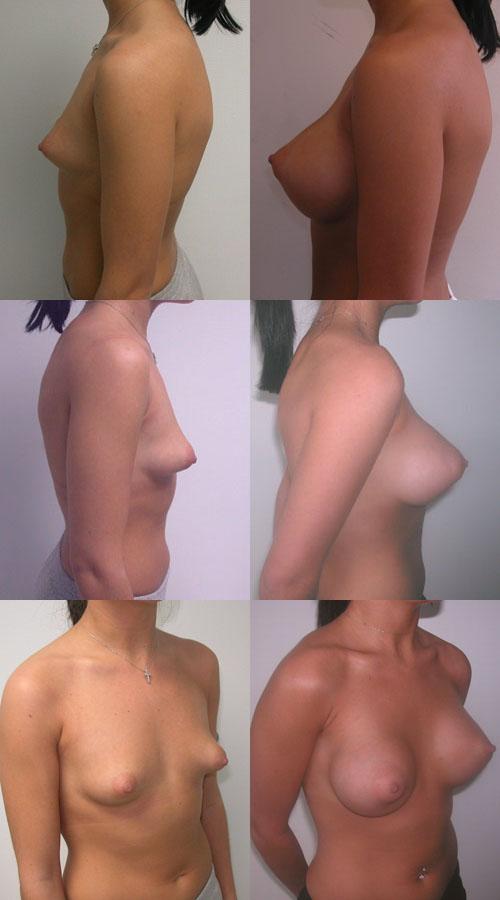 коррекция тубулярной груди