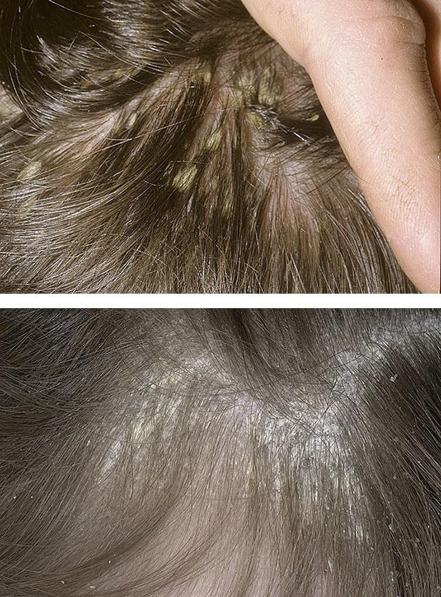 Захворювання шкіри голови: грибкові та гнійничкові, себорея, псоріаз » журнал здоров'я iHealth 1