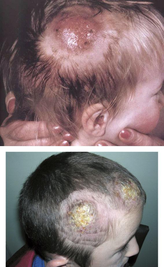 Захворювання шкіри голови: грибкові та гнійничкові, себорея, псоріаз » журнал здоров'я iHealth 4