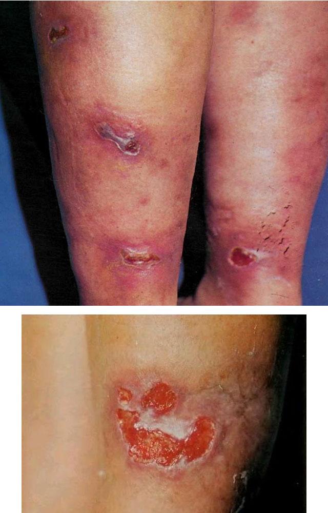 Индуративный (уплотненный) кожный туберкулез