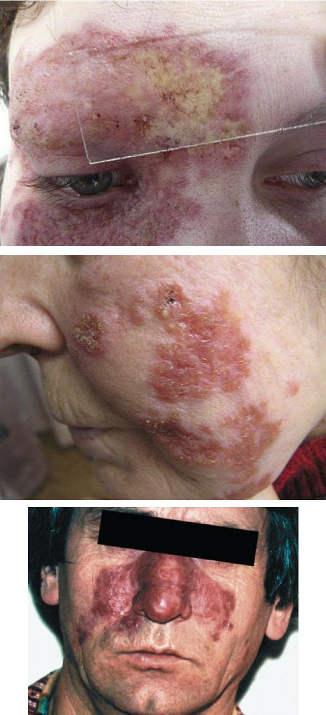 Люпоидный туберкулез кожи