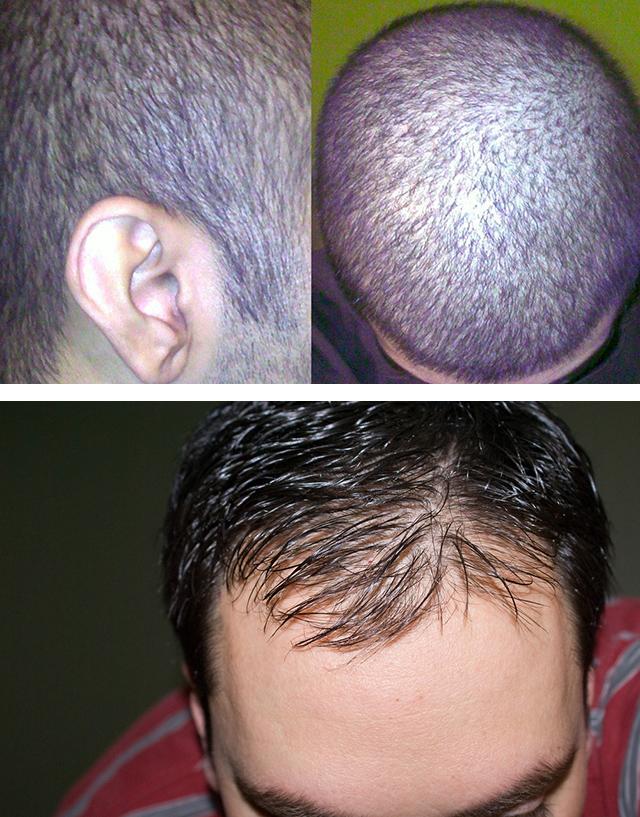 Випадання волосся у чоловіків: причини, засоби і методи лікування різних форм облисіння » журнал здоров'я iHealth 1