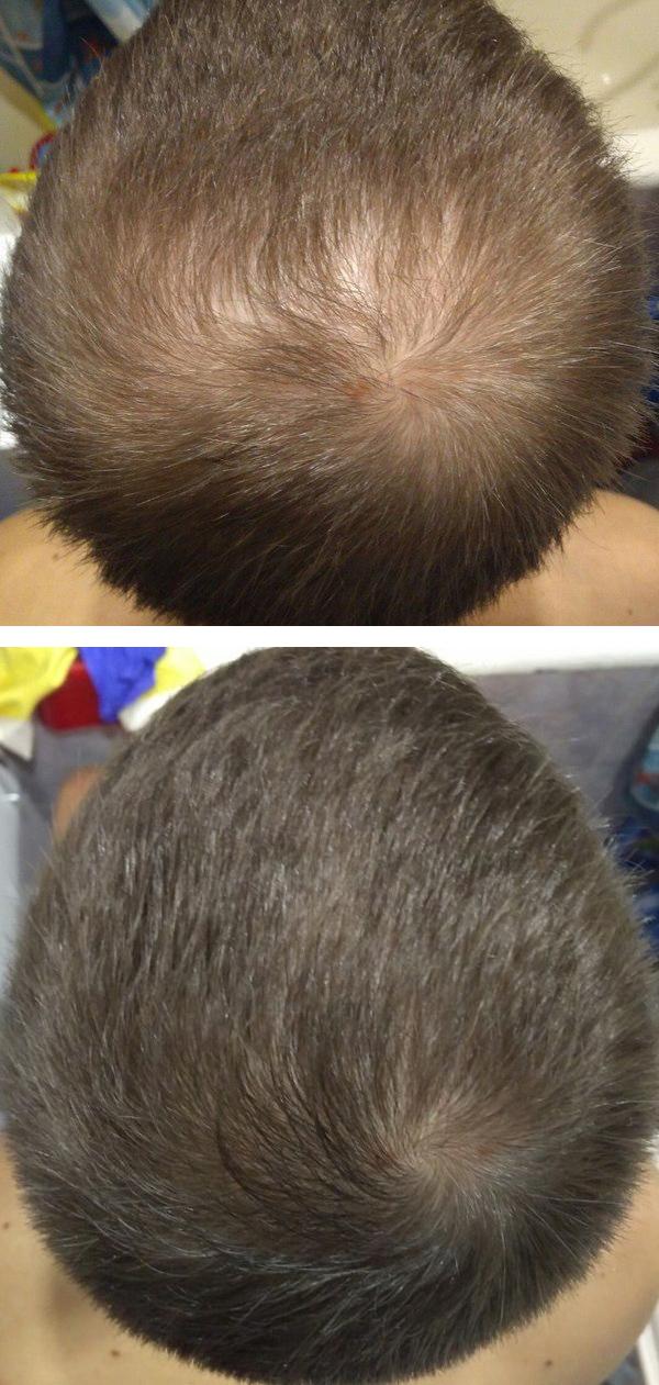Випадання волосся у чоловіків: причини, засоби і методи лікування різних форм облисіння » журнал здоров'я iHealth 3