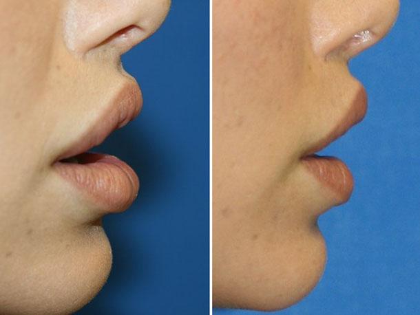 Видалення гіалуронової кислоти з губ – як боротися з невдало введеним филлером? » журнал здоров'я iHealth 1