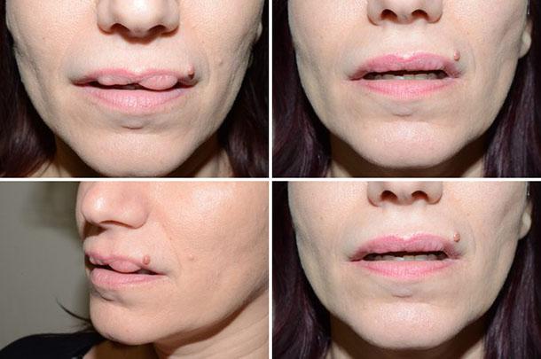 Видалення гіалуронової кислоти з губ – як боротися з невдало введеним филлером? » журнал здоров'я iHealth 