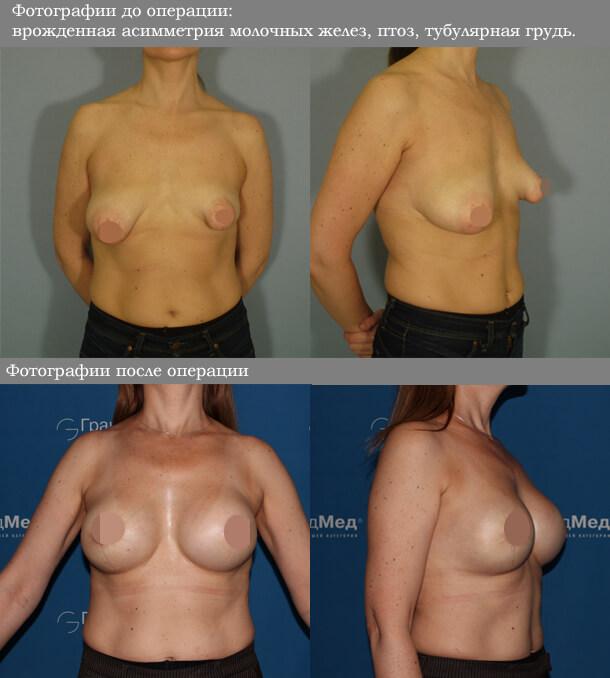 Пластическая операция по устранению асимметрии груди