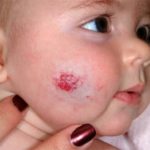 Чем опасна гемангиома на лице и коже у ребенка — ТОП самых эффективных способов лечения