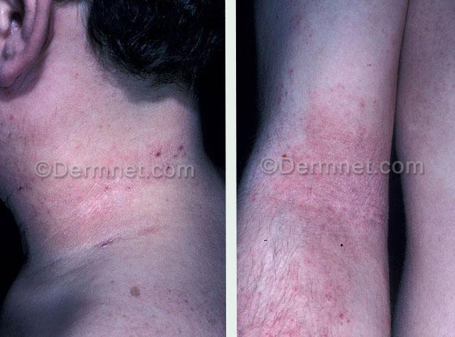 atopicheskij-dermatit-foto