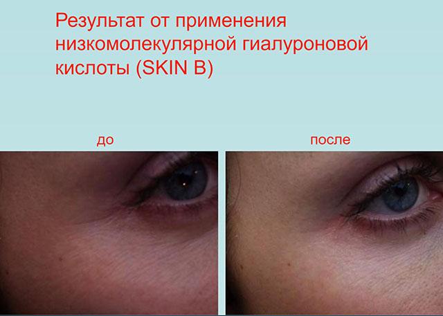 биоревитализация skin b