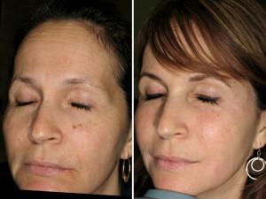 Коллаген инъекции для лица фото до и после