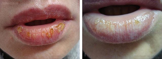 осложнения после контурной пластики губ - эксфолиативный хейлит