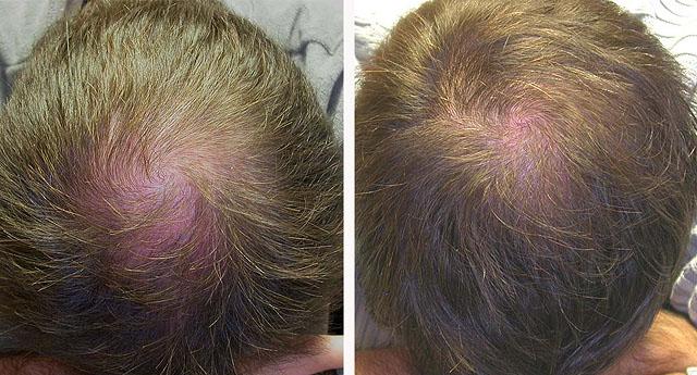 лечение волос мезотерапией