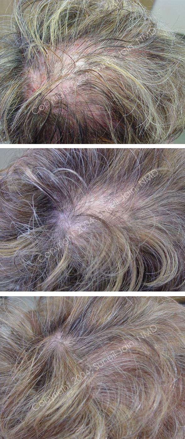 мезотерапия от выпадения волос