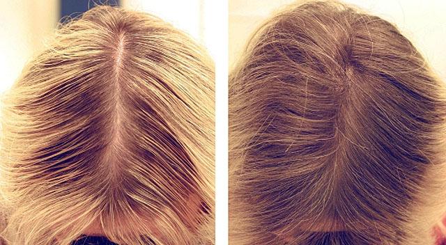 Мезотерапия волос противопоказания последствия
