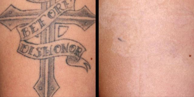 Противопоказания при удалении татуировки лазером