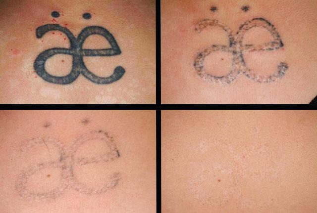 удаление татуировки методом лазерной шлифовки