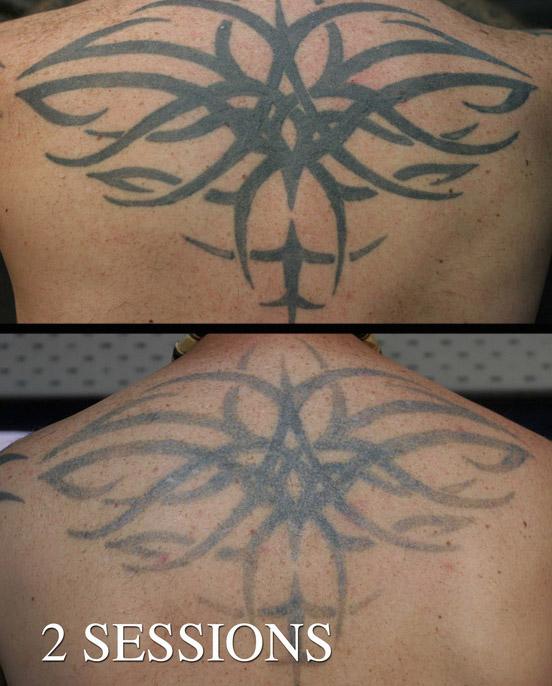удаление татуировки методом селективного фототермолиза