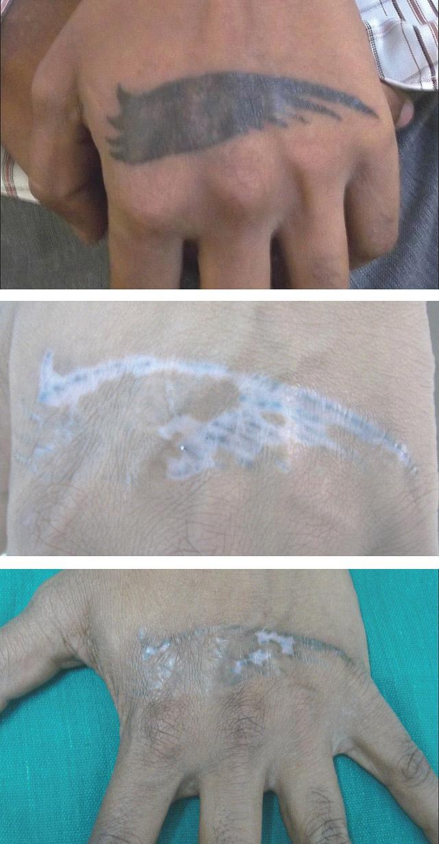 удаление татуировки неодимовым лазером с последующей репигментацией
