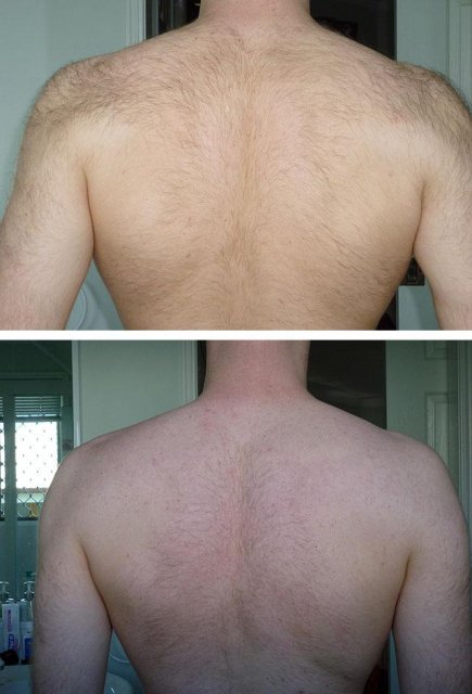 Фото до и после процедуры электроэпиляции: результаты и последствия