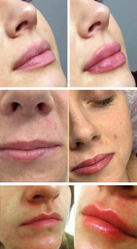 Электропорация губ что это такое, цена, отзывы, фото до и