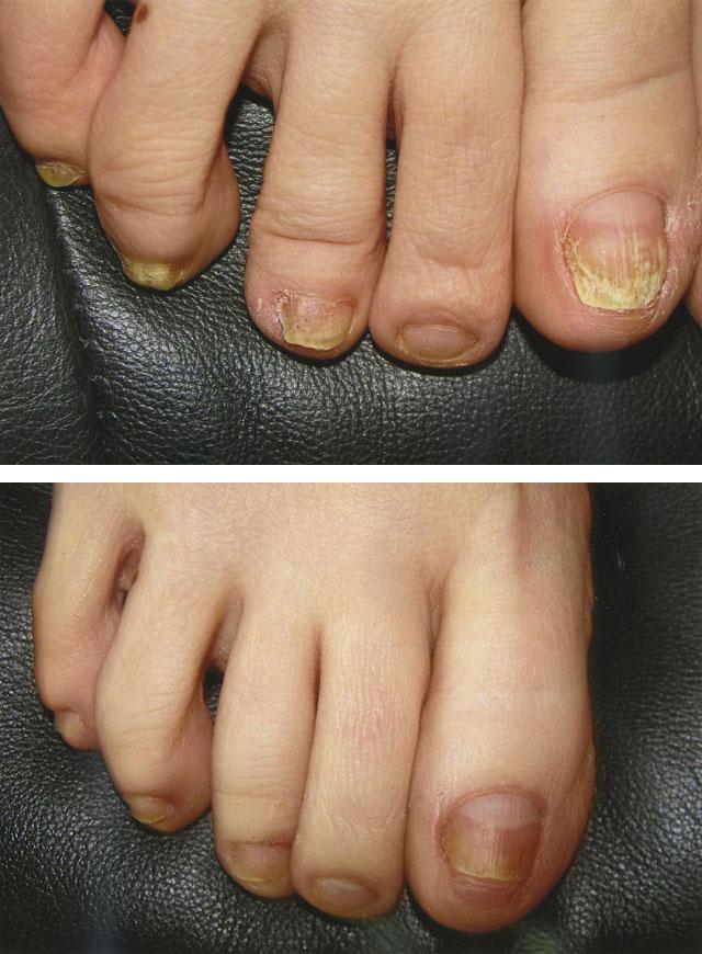 лазерное лечение ногтевого грибка