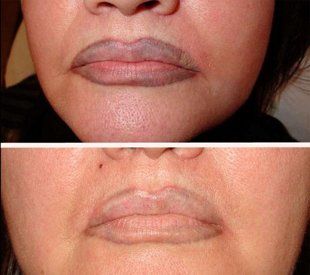 лазерное удаление перманентного макияжа губ