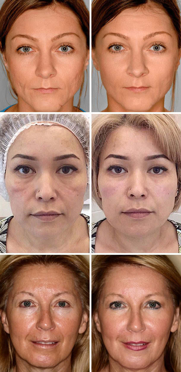 Фото до и после применения препарата Гиалуформ