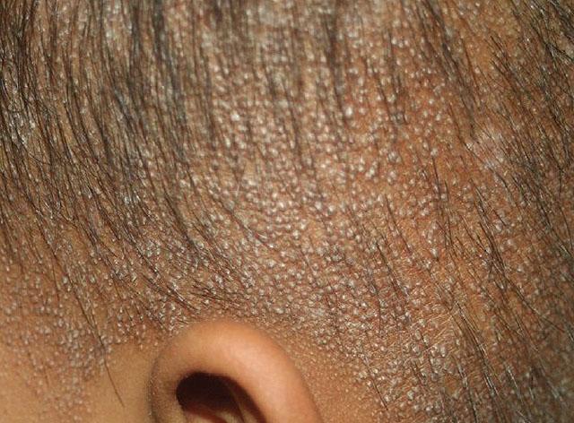 Клиническая картина фолликулярного гиперкератоза кожи головы