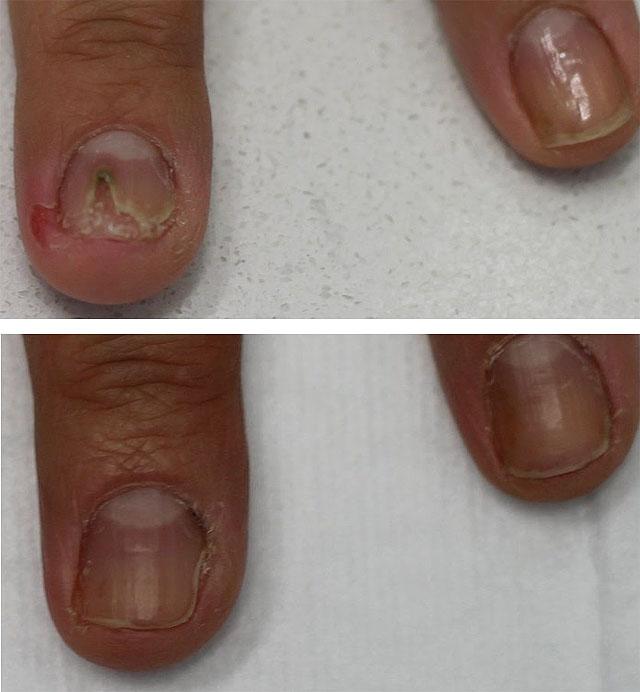 лечение грибка ногтей на руках