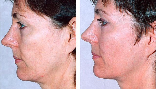 термаж лица фото до и после процедуры
