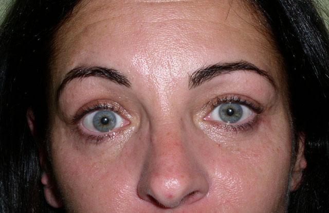 Осложнение после блефаропластики, выраженное в синдроме круглого глаза