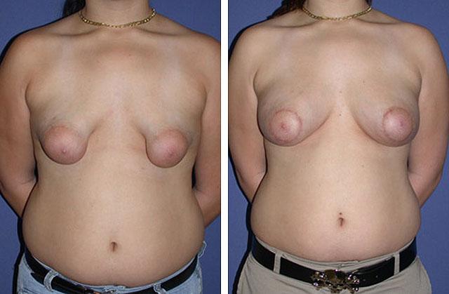 Периареолярная  мастопексия с одномоментным протезированием грудных желез