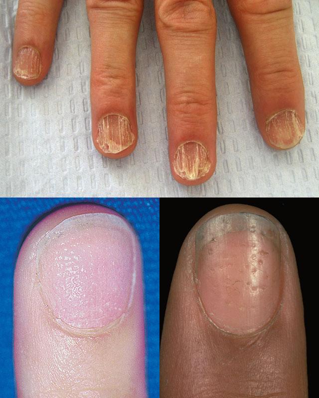 Дистрофия ногтевой пластины при тяжелых проявлениях очаговой алопеции