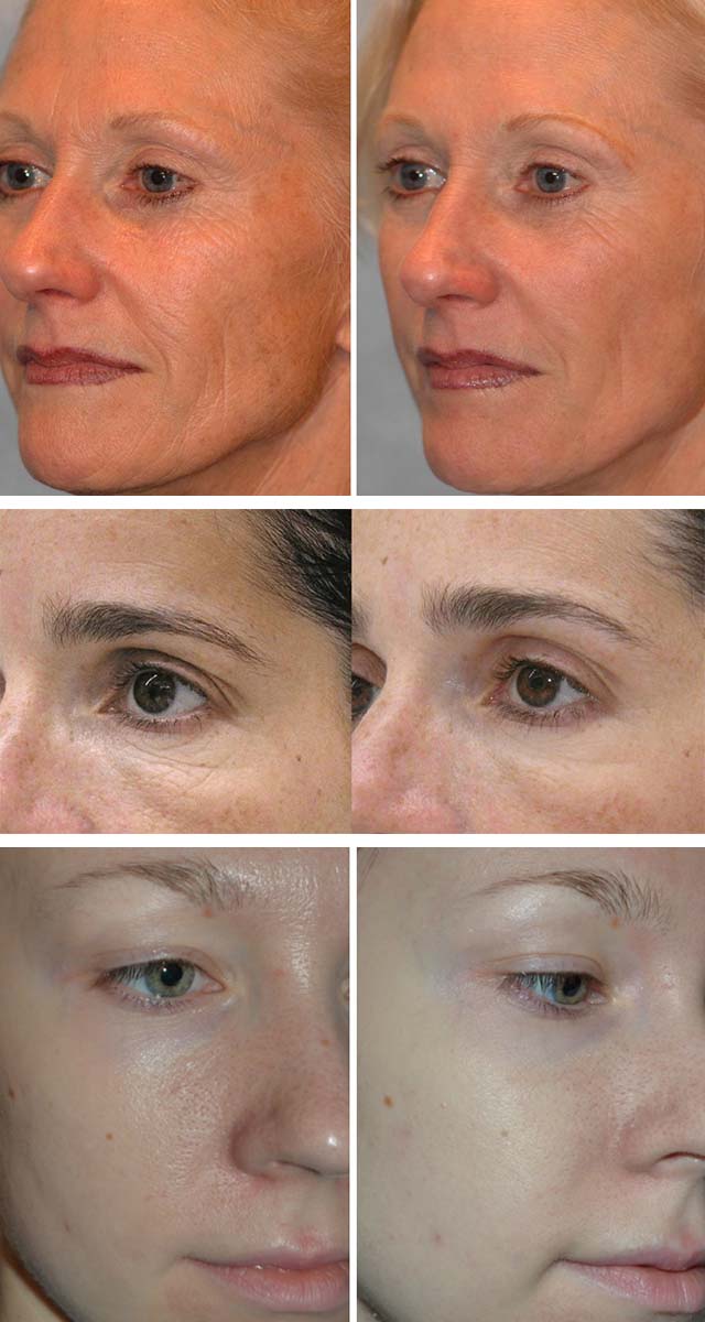 Фото до и после ионофореза на лице