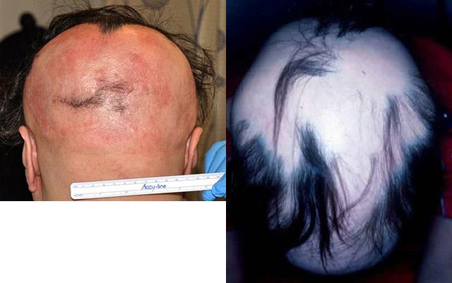 Полное выпадение волос ресниц бровей у мужчин причины лечение