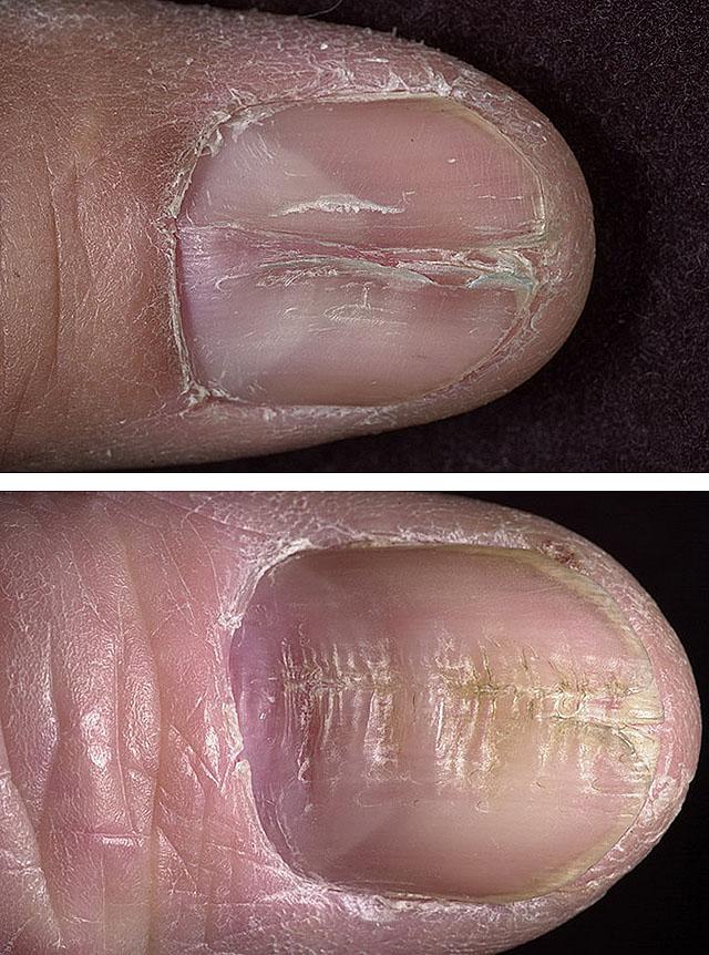 Срединная каналообразная дистрофия ногтевой пластины