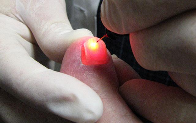 лазерная коррекция вросшего ногтя